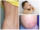 Bedbugs menggigit wanita dan kanak-kanak