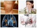 Alergija, širdies ligos, tuberkuliozė