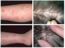 Mga Flea at Lice Bites