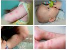 Picadas de pulga em uma criança