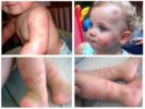 Allergi mot vägglöss hos barn
