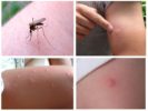 Mușcături de țânțari