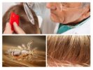 Pedikulozės plaukų tyrimas
