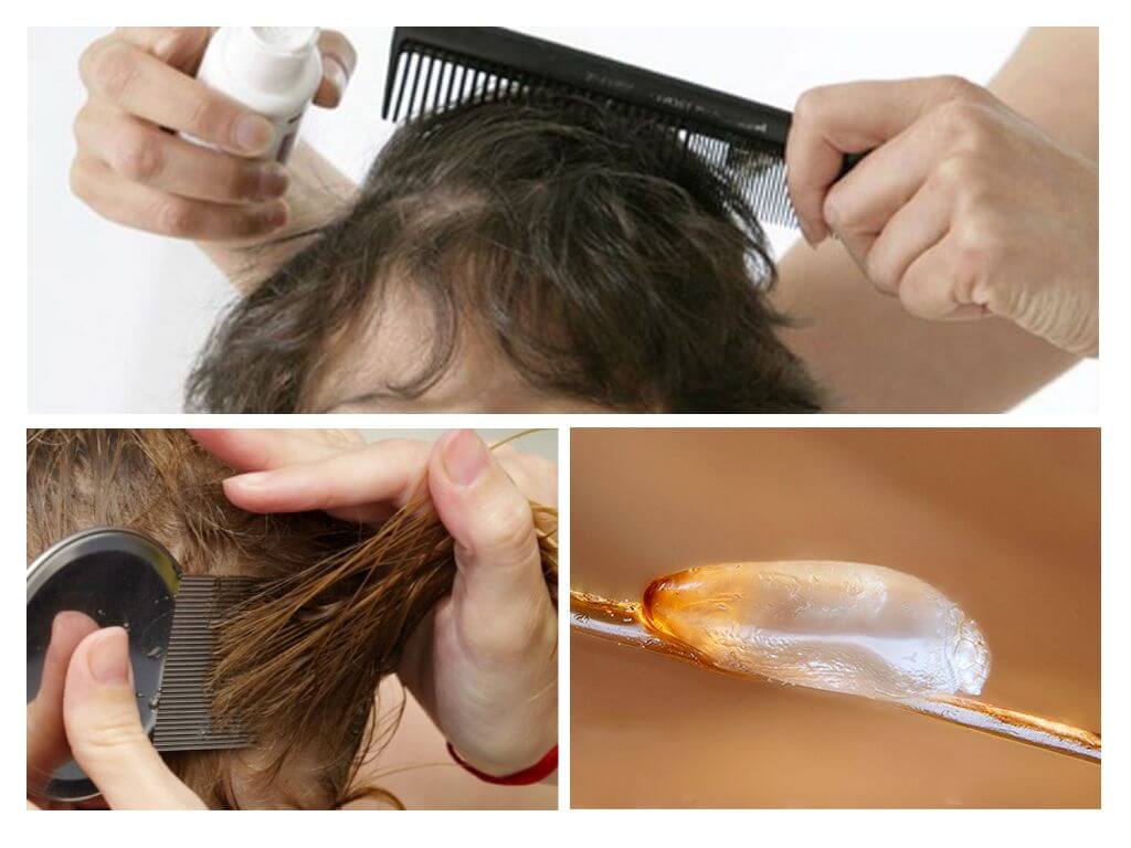 Kaip išsišukuoti nits
