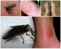 Morso di insetto su un corpo umano