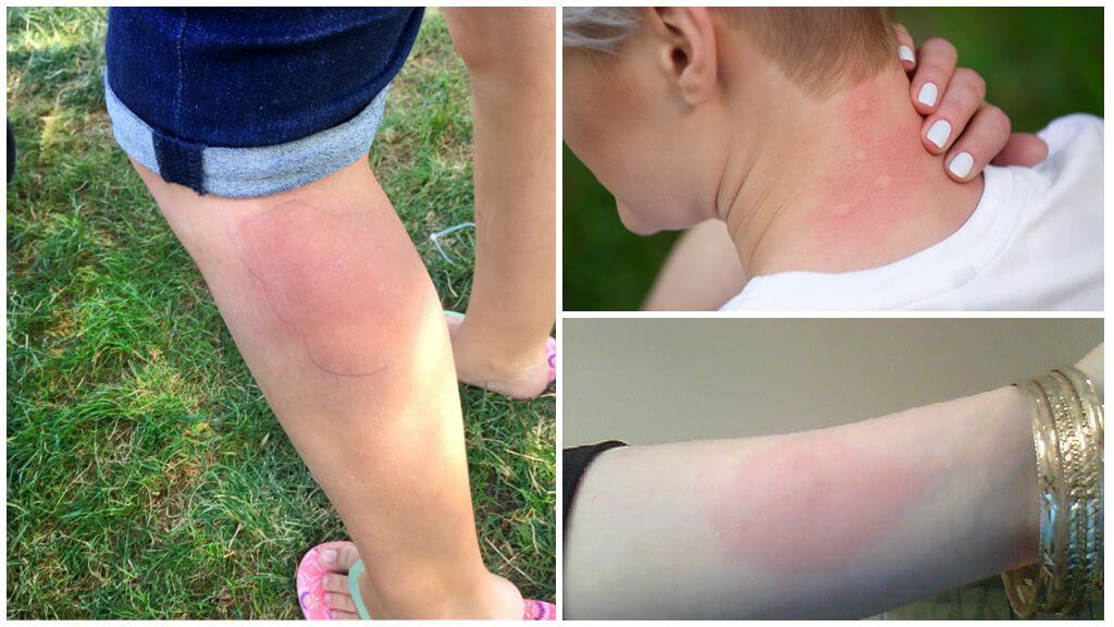 Tratamento de alergias a picadas de mosquito em um adulto e uma criança