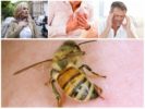 Le conseguenze di una puntura d'ape