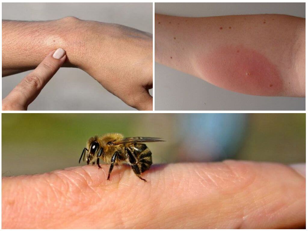 Una reazione allergica a una puntura d'ape, cosa fare