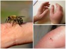 Skada från en bi