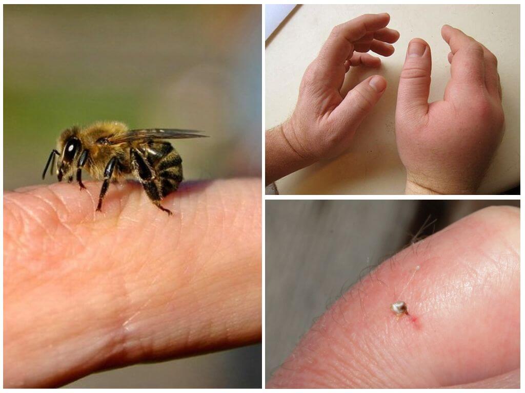 Che cosa è una puntura d'ape utile per una persona
