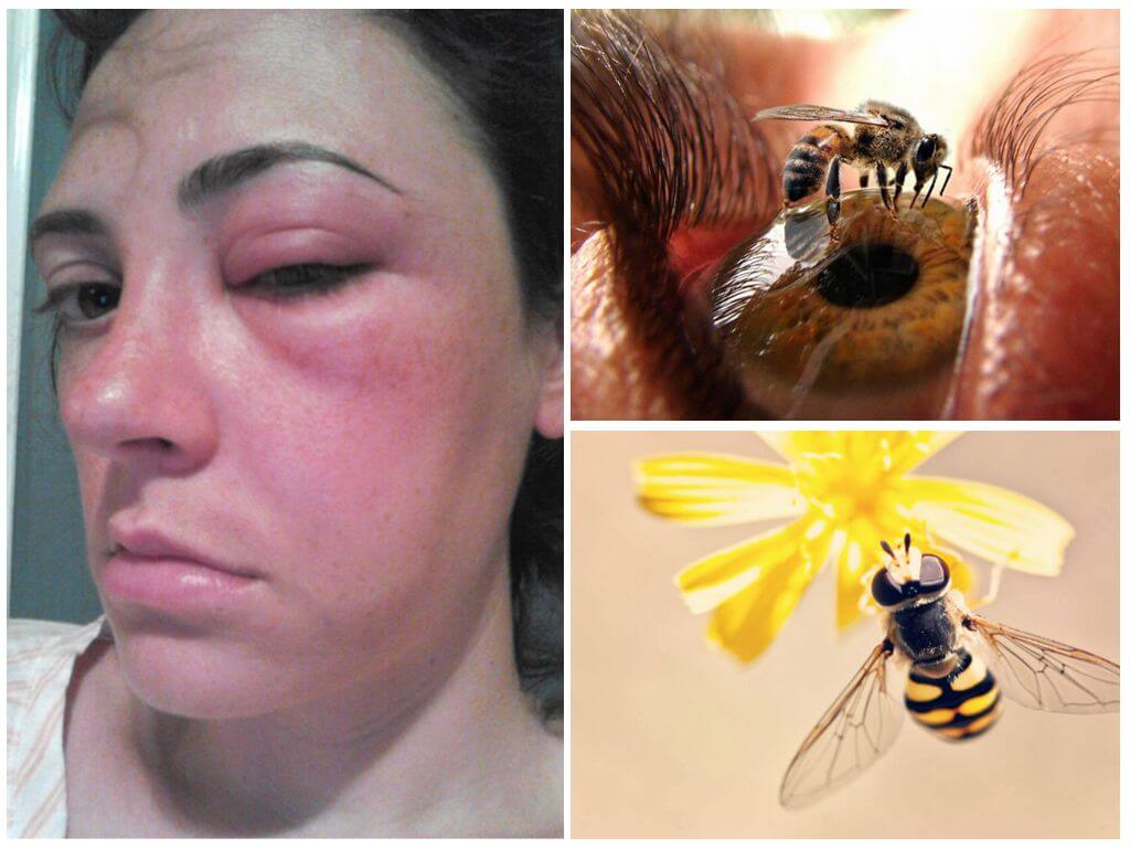 Co zrobić, jeśli pszczoła ugryzła się w oko i była spuchnięta