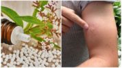 Homeopatiska medel för en negativ reaktion på myggbett