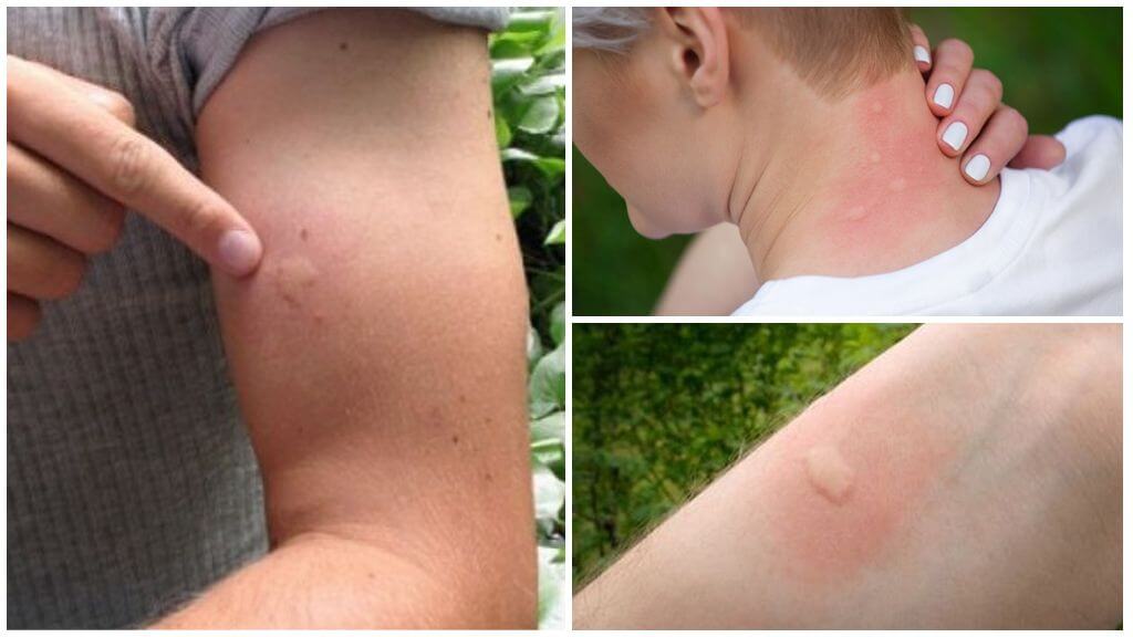 Πώς να απαλλαγείτε από το πρήξιμο και τον κνησμό από τα τσιμπήματα των κουνουπιών σε ένα παιδί και έναν ενήλικα