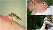 Τσιμπήματα κουνουπιών
