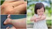 Mușcături de țânțari