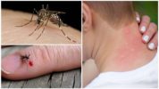 עקיצת יתושים