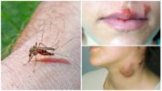 Sivrisineklerden sıtma ve tularemi