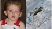 Inchaço dos olhos de uma criança por picada de mosquito