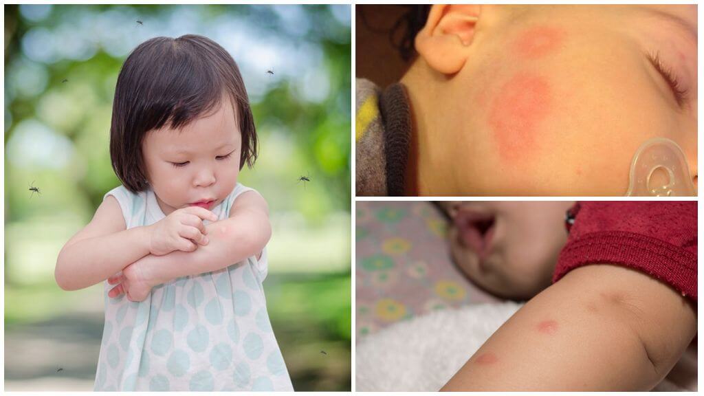 Комар ухапва по кожата на възрастен или дете