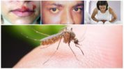 Malārijas moskīta koduma iespējamās sekas