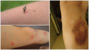 Um machucado de uma picada de mosquito