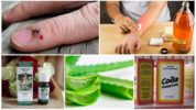 Remedii populare pentru mușcături de țânțar și mușchi
