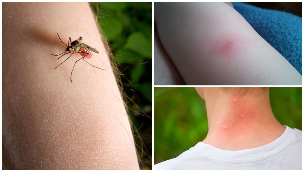 מה ההבדל בין עקיצת יתוש לנגוס באג או קרציות