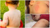 Muỗi đốt ở trẻ em