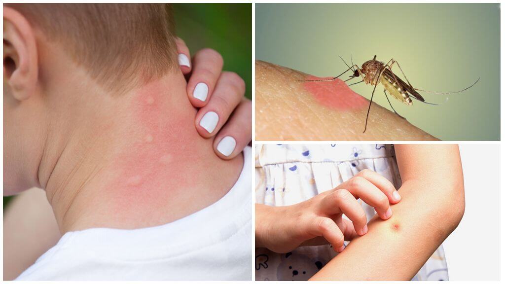 Warum Mückenstiche jucken