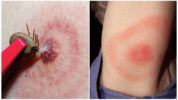 Ziekte van Lyme of door teken overgedragen borreliose