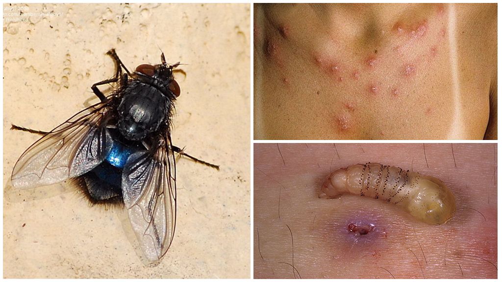 Satu lalat yang meletakkan larva di bawah kulit manusia