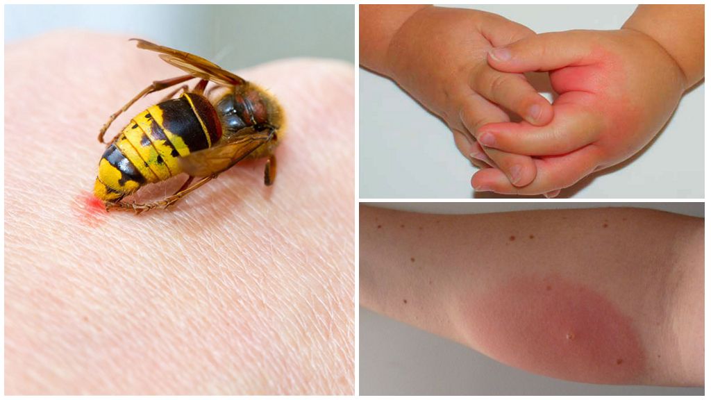 Reazione allergica a una puntura di vespa
