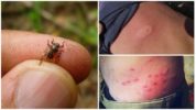 İnsanlarda bir geyik sineğinin ısırmasının sonuçları