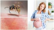 Înțepături de viespe în timpul sarcinii