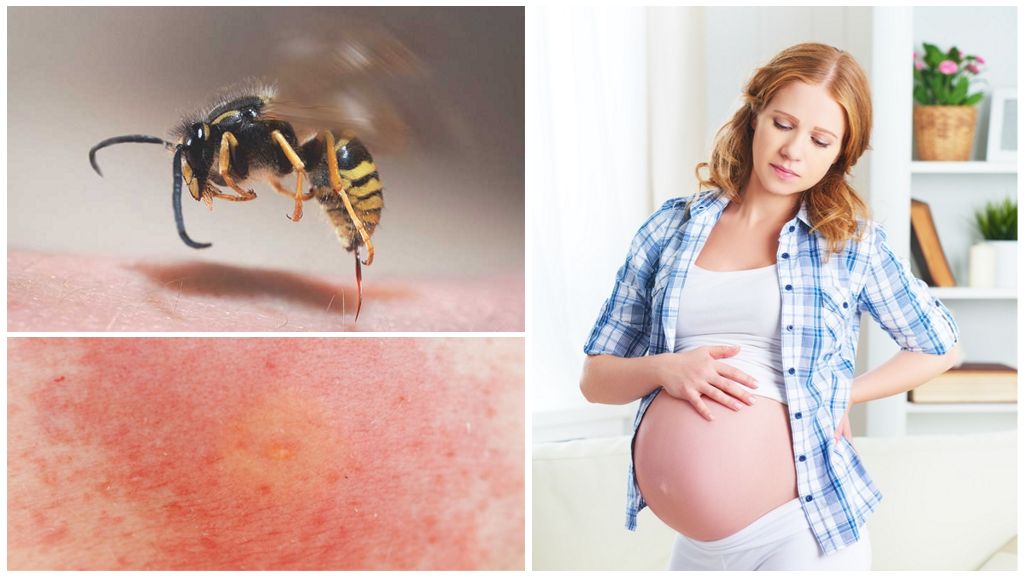 Was tun, wenn eine Wespe eine schwangere oder stillende Frau gebissen hat?
