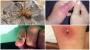 Последствия от ухапване от паяк отшелник