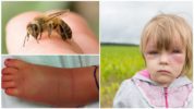 Alergija vabzdžių įkandimui