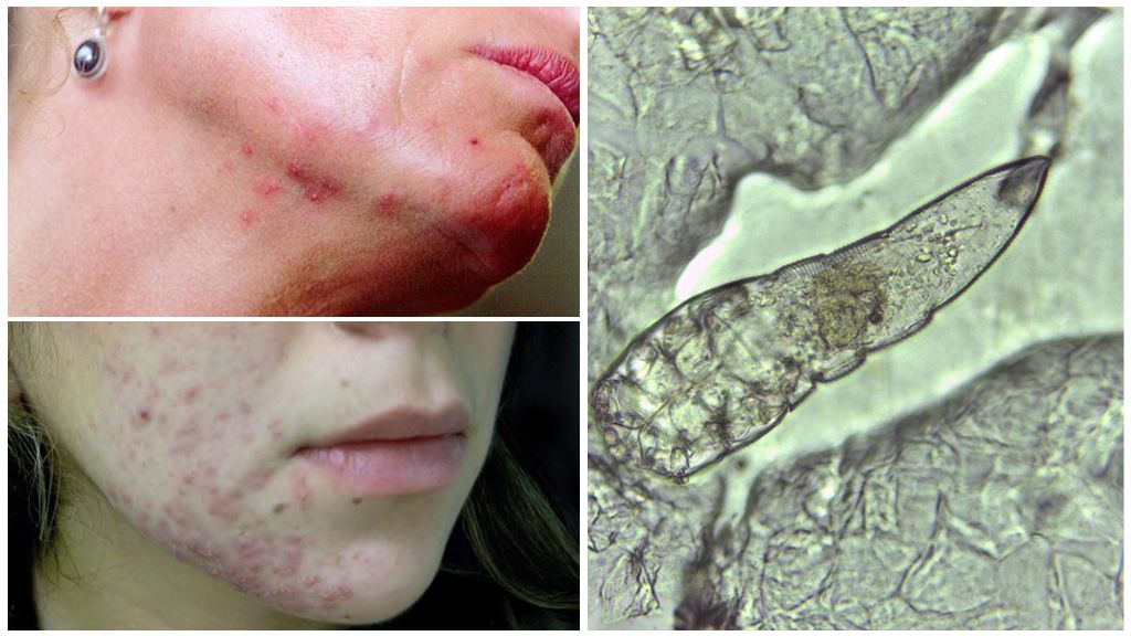 Làm thế nào là một con ve dưới da truyền trên khuôn mặt của một người?