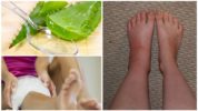 Θεραπεία για δάγκωμα εντόμων σε ένα πόδι