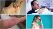Mga sintomas ng isang Allergic Reaction sa isang Bite