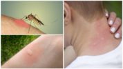 Sivrisinek ısırığı