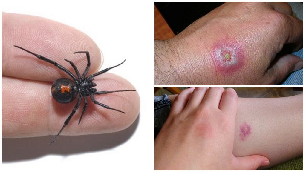 Ce să faci dacă un păianjen a mușcat