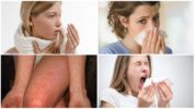 Erkių alergija