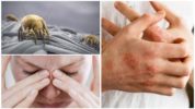 Алергия срещу акари