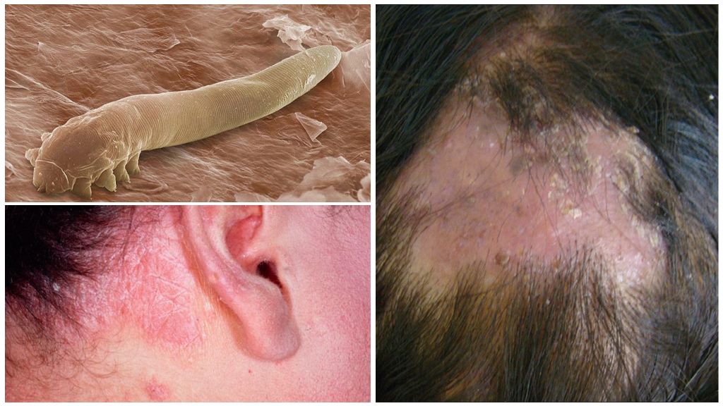 Síntomas y tratamiento de la demodicosis del cuero cabelludo.