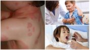 Behandeling van borreliose bij kinderen