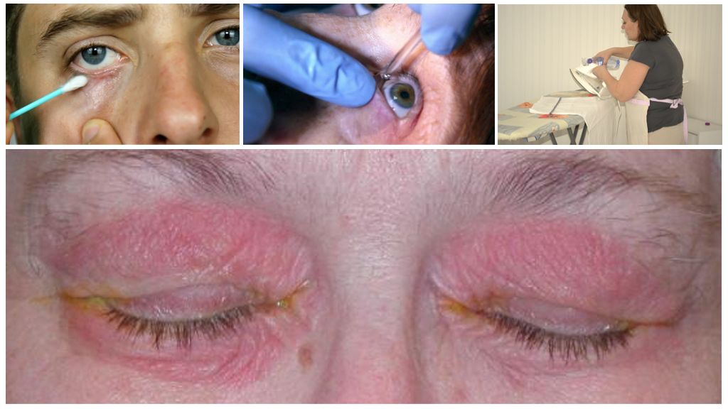 Symptome und Behandlung der Augendemodikose beim Menschen