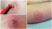 Malaltia de Lyme Tick