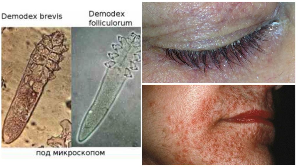 Foto, beschrijving en behandeling van huidmijt Demodex